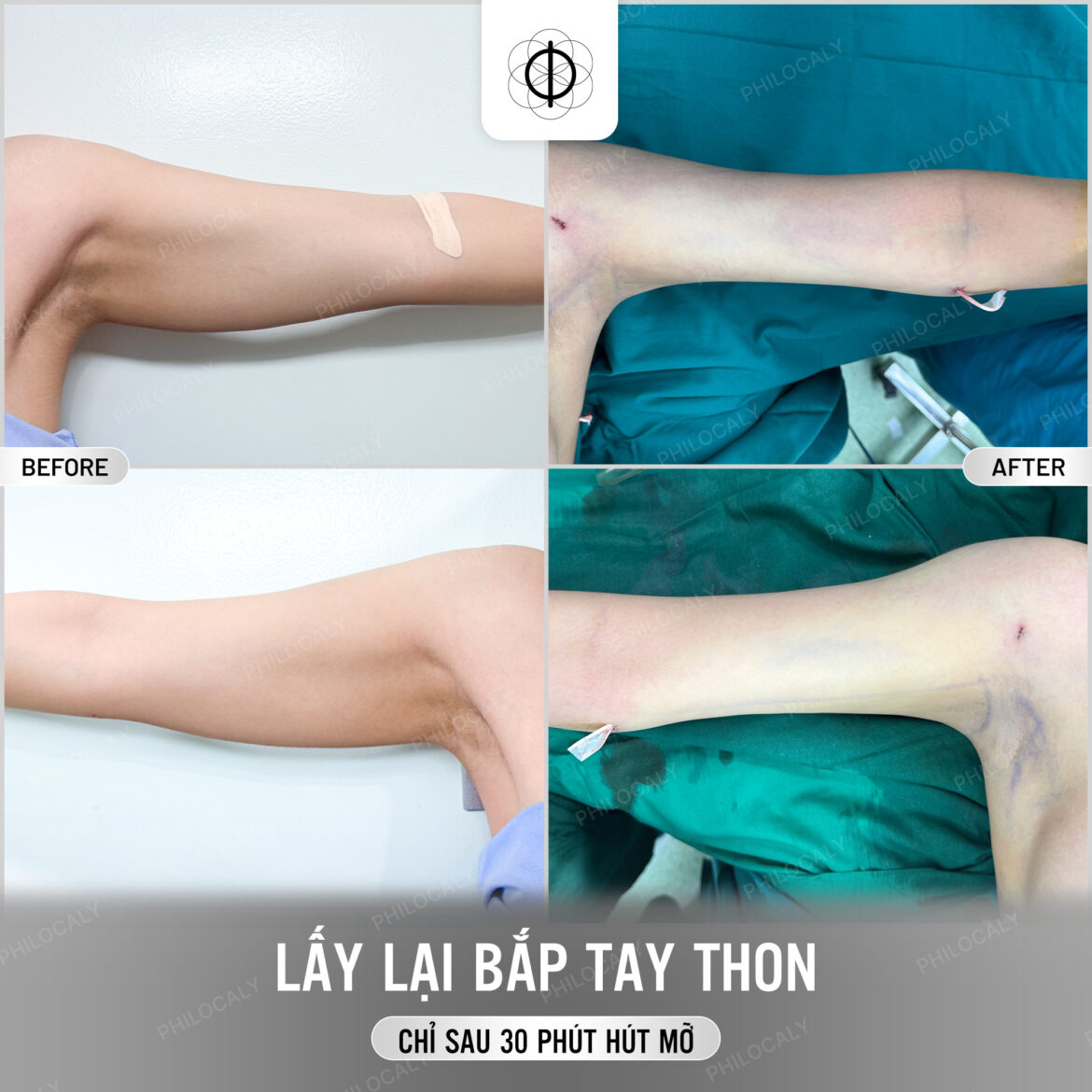 Mỡ Có Tái Tích Tụ Sau Khi Hút Mỡ Không? 