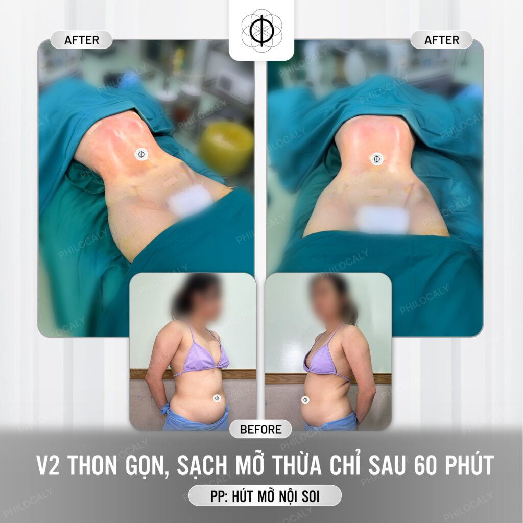 Hình ảnh trước và ngay sau khi thực hiện hút mỡ cho khách hàng
