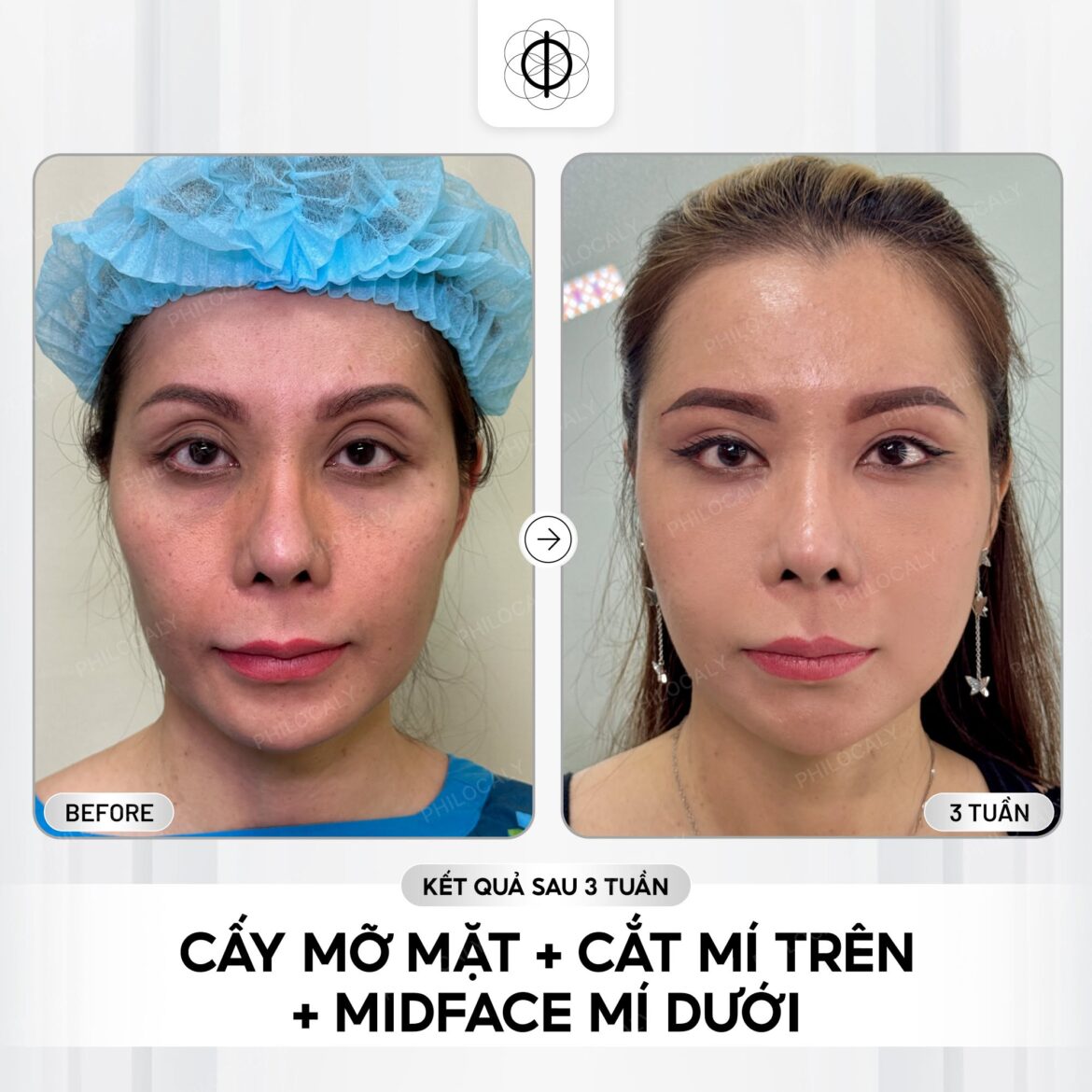 Cấy mỡ mặt + cắt mí