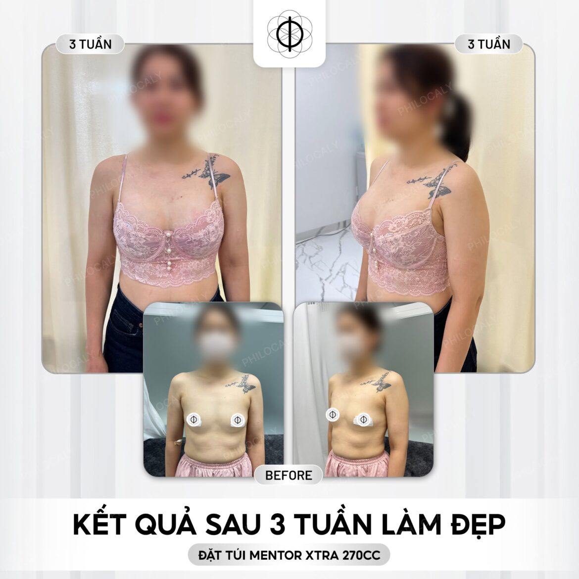 Đặt túi Mentor