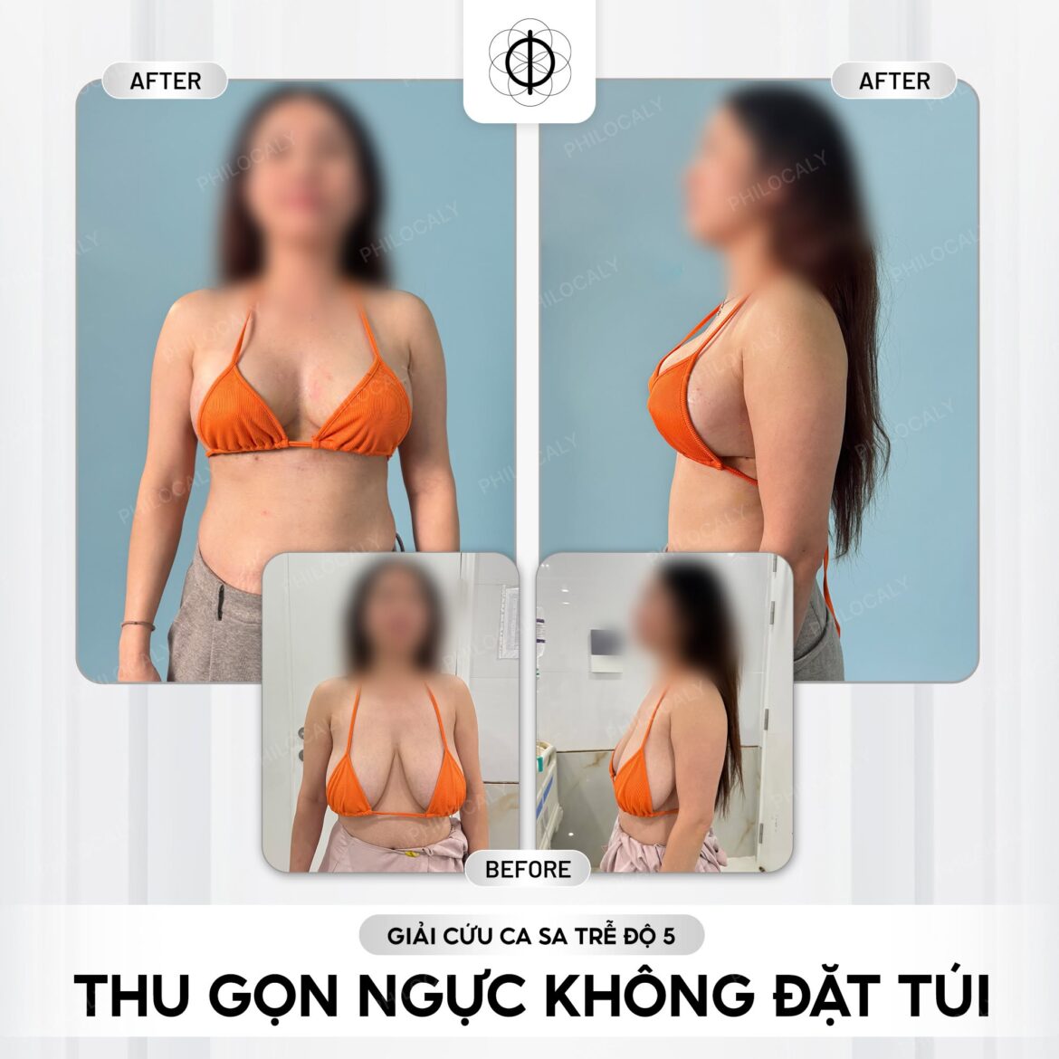 Thu gọn ngực