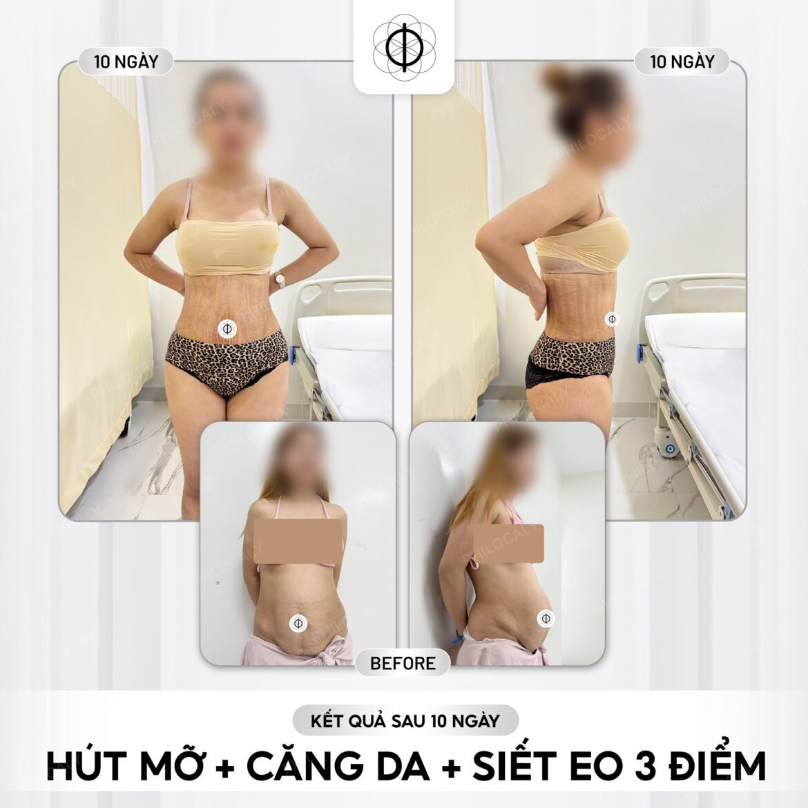 Hút mỡ siết eo