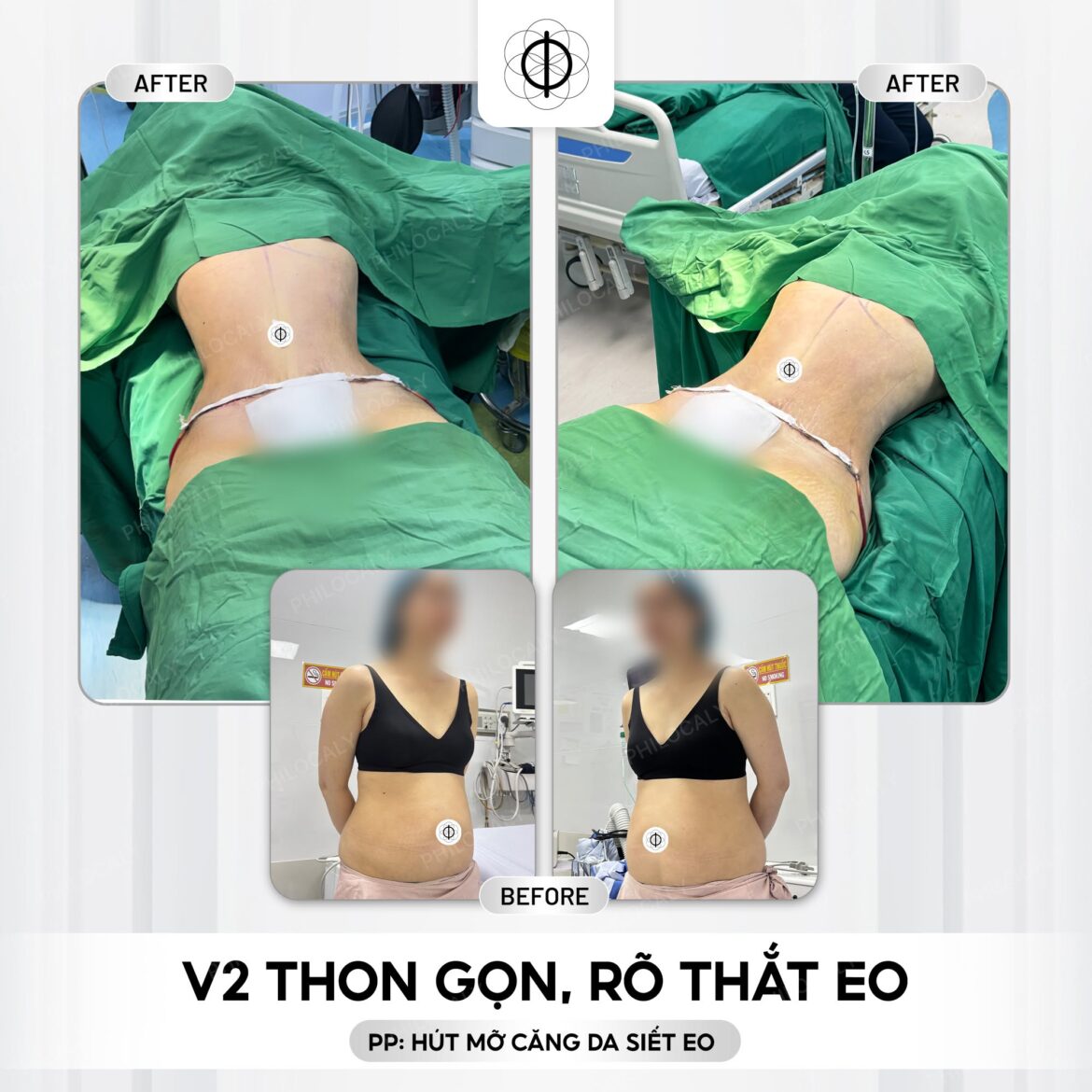 Hút mỡ V2