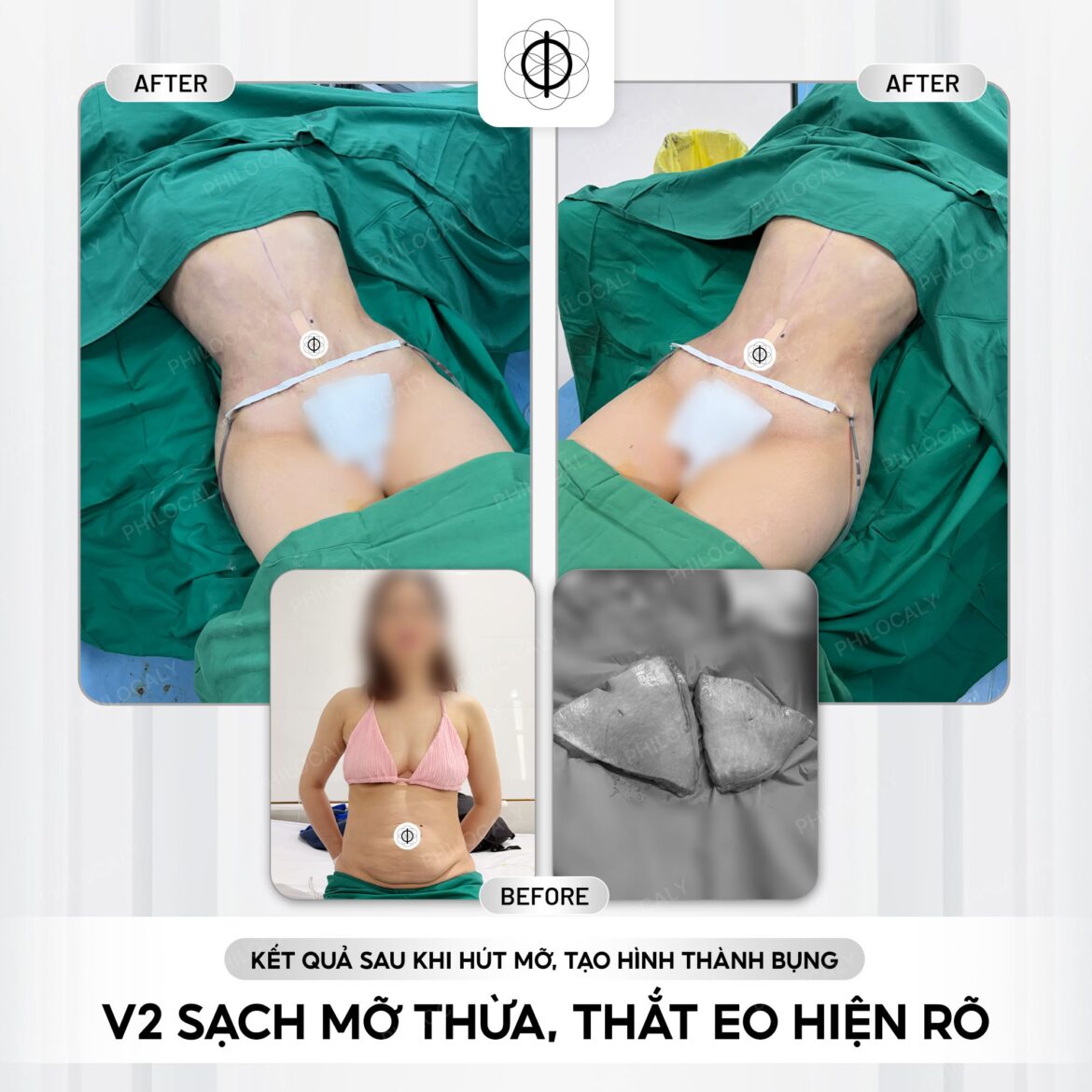 Hút mỡ bụng